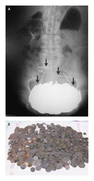 Radio montrant une masse dans lestomac